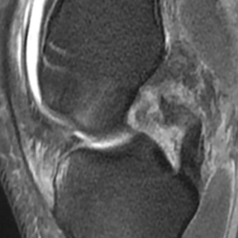 Sagittal MRI scan showing a ruptured posterior cruciate ligament in the centre of the knee